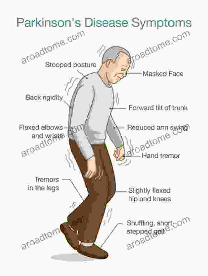 A Depiction Of A Person With Parkinson's Disease, Showing Tremors And Rigidity Parkinson Disease An Issue Of Clinics In Geriatric Medicine E (The Clinics: Internal Medicine 36)