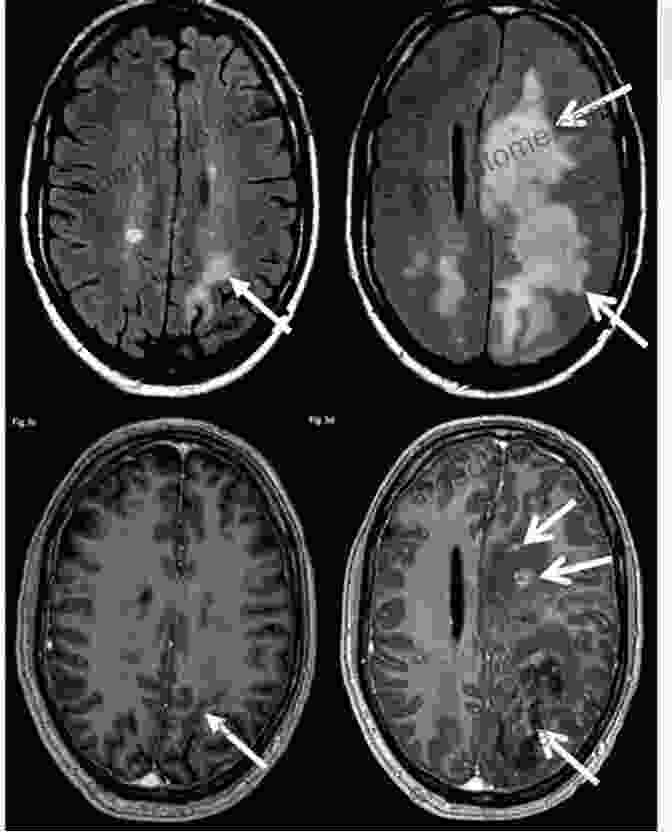 Multiple Sclerosis Brain Scan Showing Lesions Multiple Sclerosis? You Can Do It : Overcoming Multiple Sclerosis In Practice