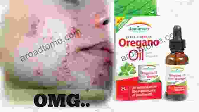 Oregano Oil Applied To Acne Prone Skin The Powerful Herbal Remedy: How Oregano Can Reverse Numerous Ailments